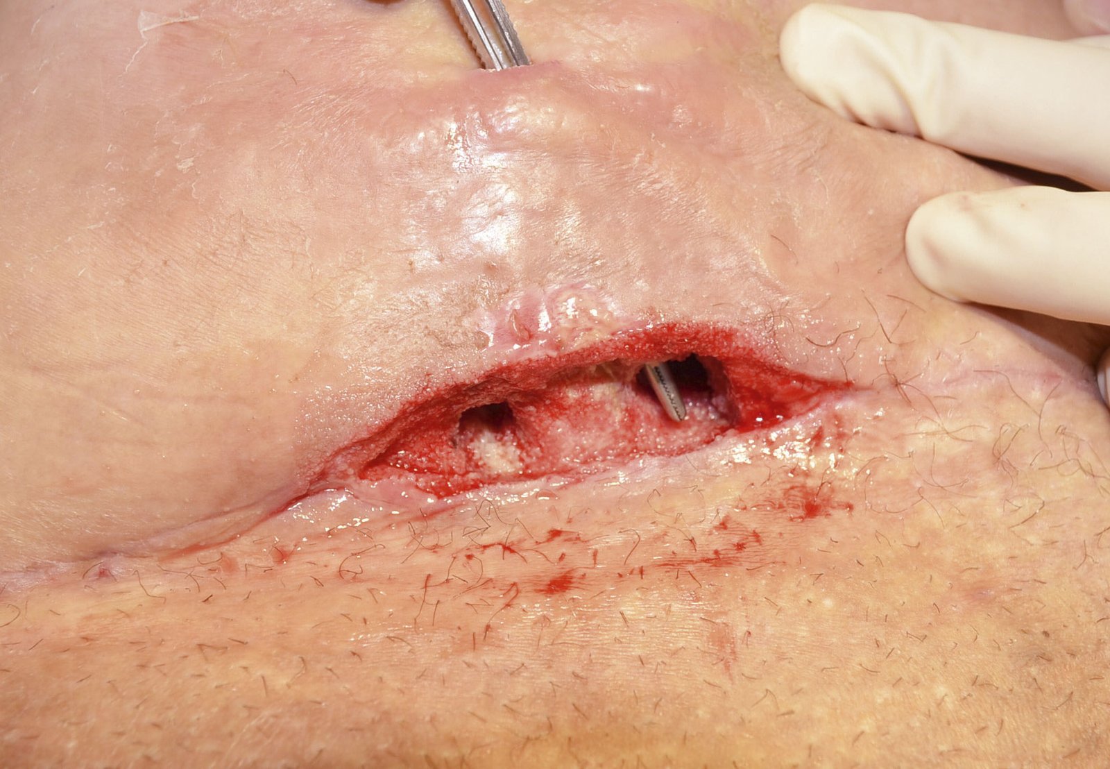 Antiinf.wirk.Verb. Alginate1li Zustand nach postoperativem Abszess nach Kaiserschnitt