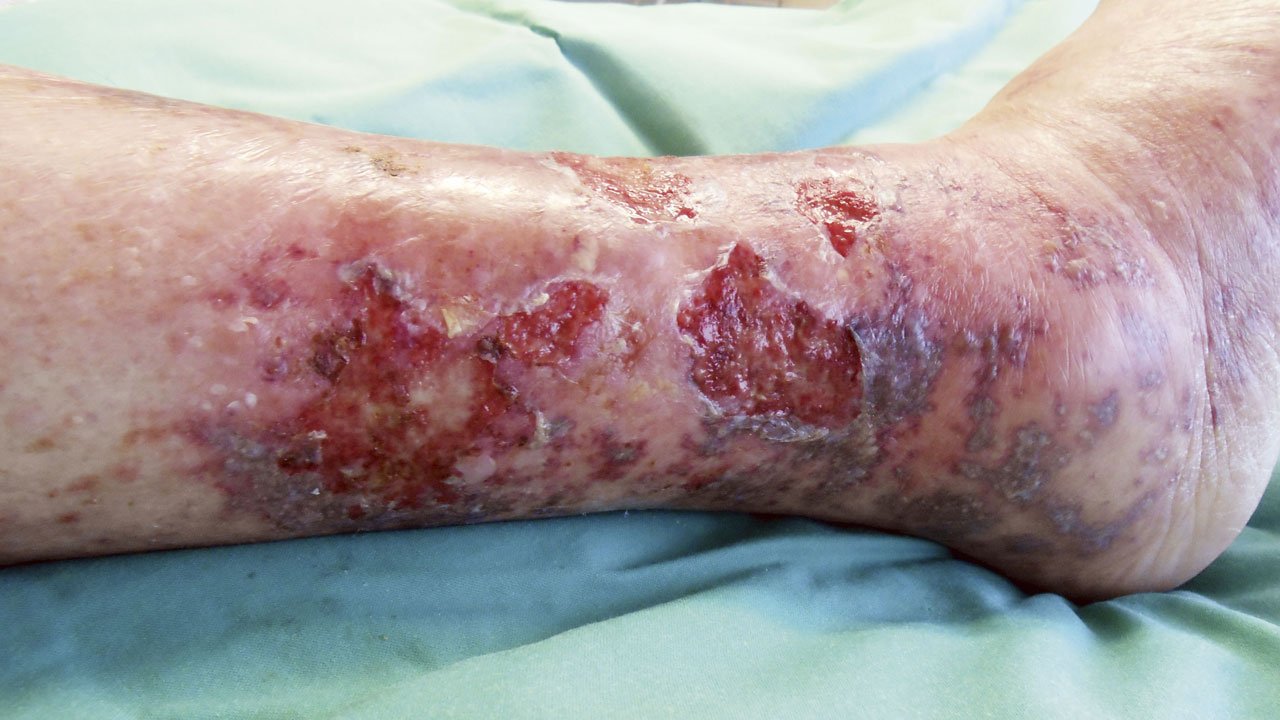 Antiinf.wirk.Verb. antimik phys1li Infiziertes Ulcus cruris venosum UCV