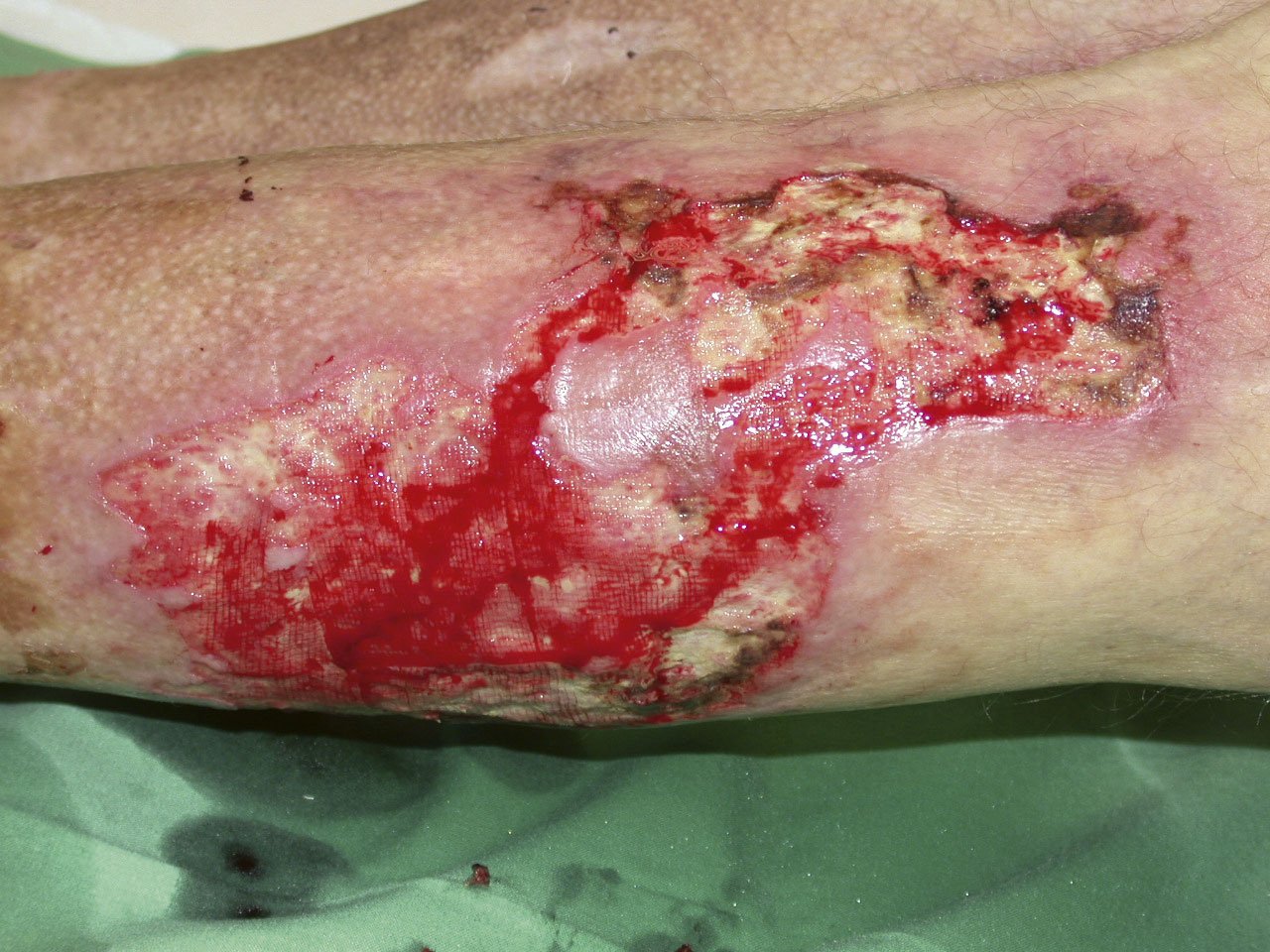 Antiinf.wirk.Verb. antimik phys2re Infizierte diabetische Ulzerationen am Unterschenkel