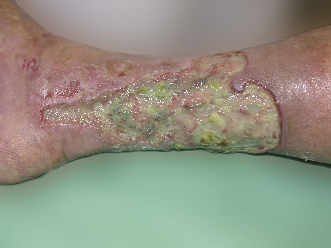 Antiinf.wirk.Verb. geruchsabs1li Stark riechende Pseudomonas Infektion bei Ulcus curirs venosum