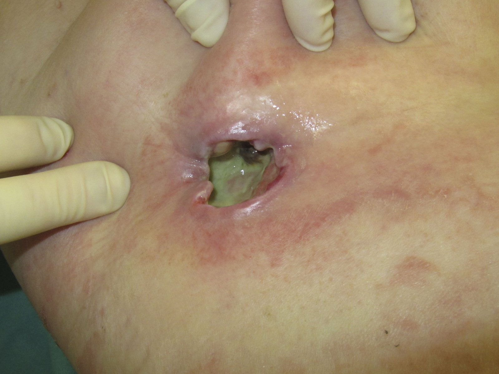 Antiinf.wirk.Verb. geruchsabs2re Jauchig stinkender zerfallender Mamma Tumor