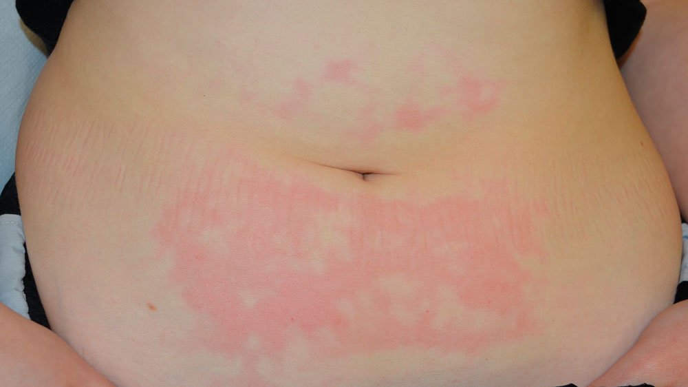 Bild 2 Verbrennung durch heißen Wasserdampf 1