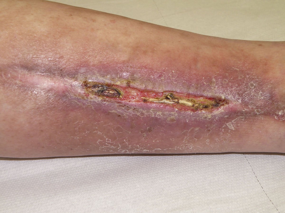 Enzyme2re Teils nekrotische postoperative Wunde an der Wade