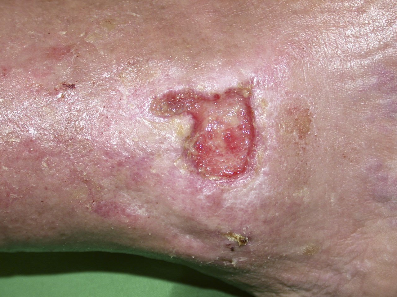 Hydroakt.Verb.1li Gering exsudierendes UCV am Außenknöchel