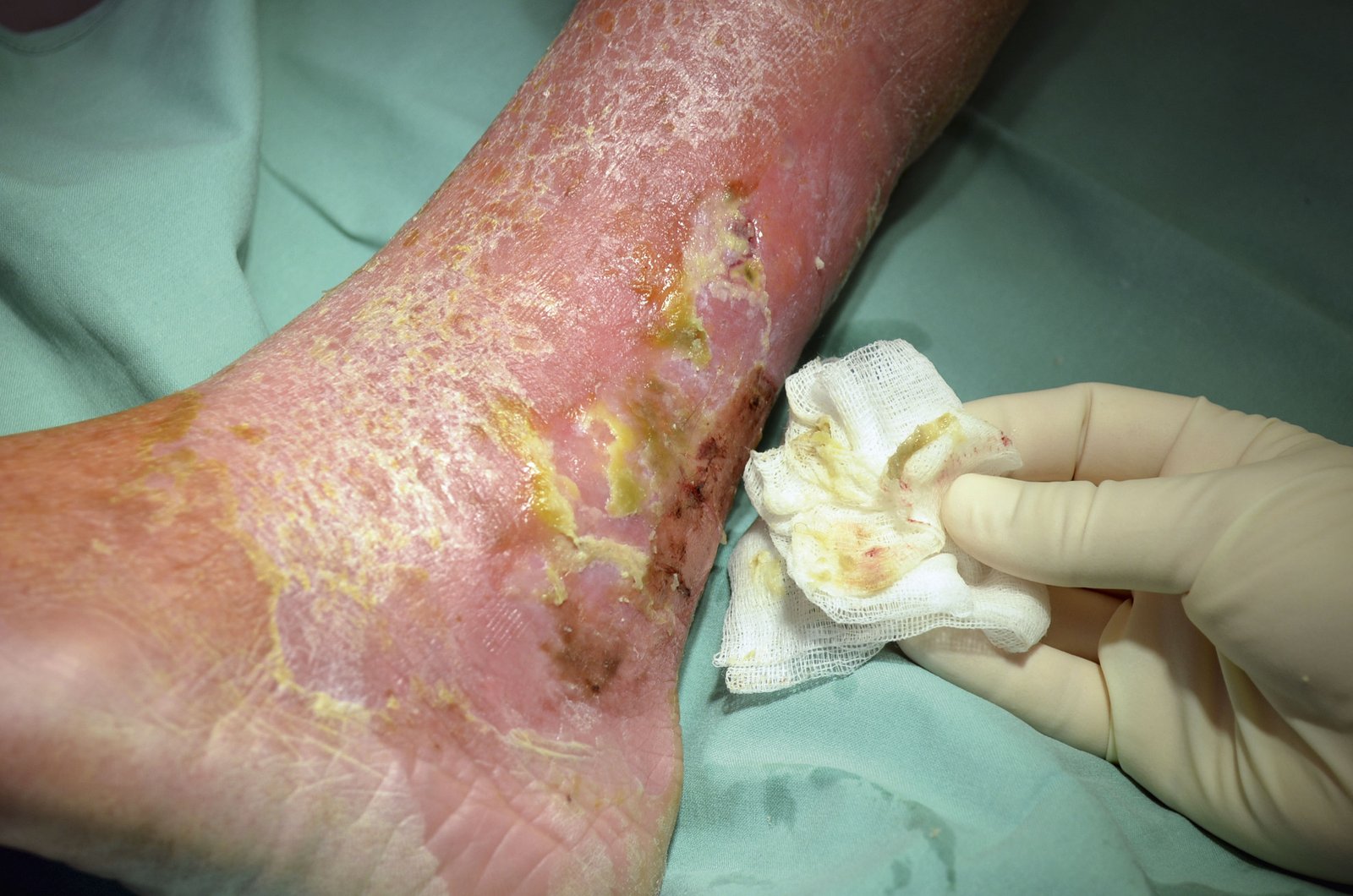 Wundspüllösung1li Druckulkus an der Ferse Fettgewebsnekrose kaum Exsudation