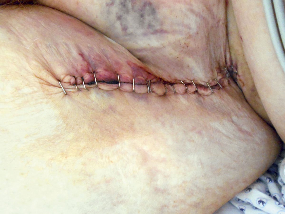 Wundspüllösung2re Dekubitus am Gesäß mit Restnekrosen am Wundgrund