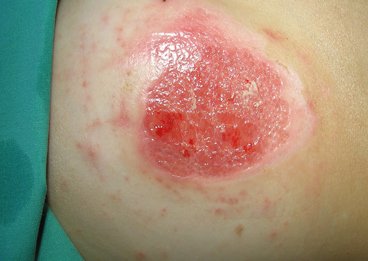 PU Hydro Bild re Zustand nach Verbrühung 2a gradig