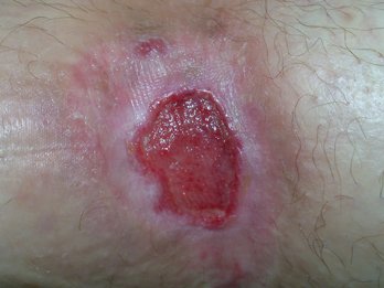 PUHydro Bild li Ulkus in der Kniebeuge bei Artefakthandlung