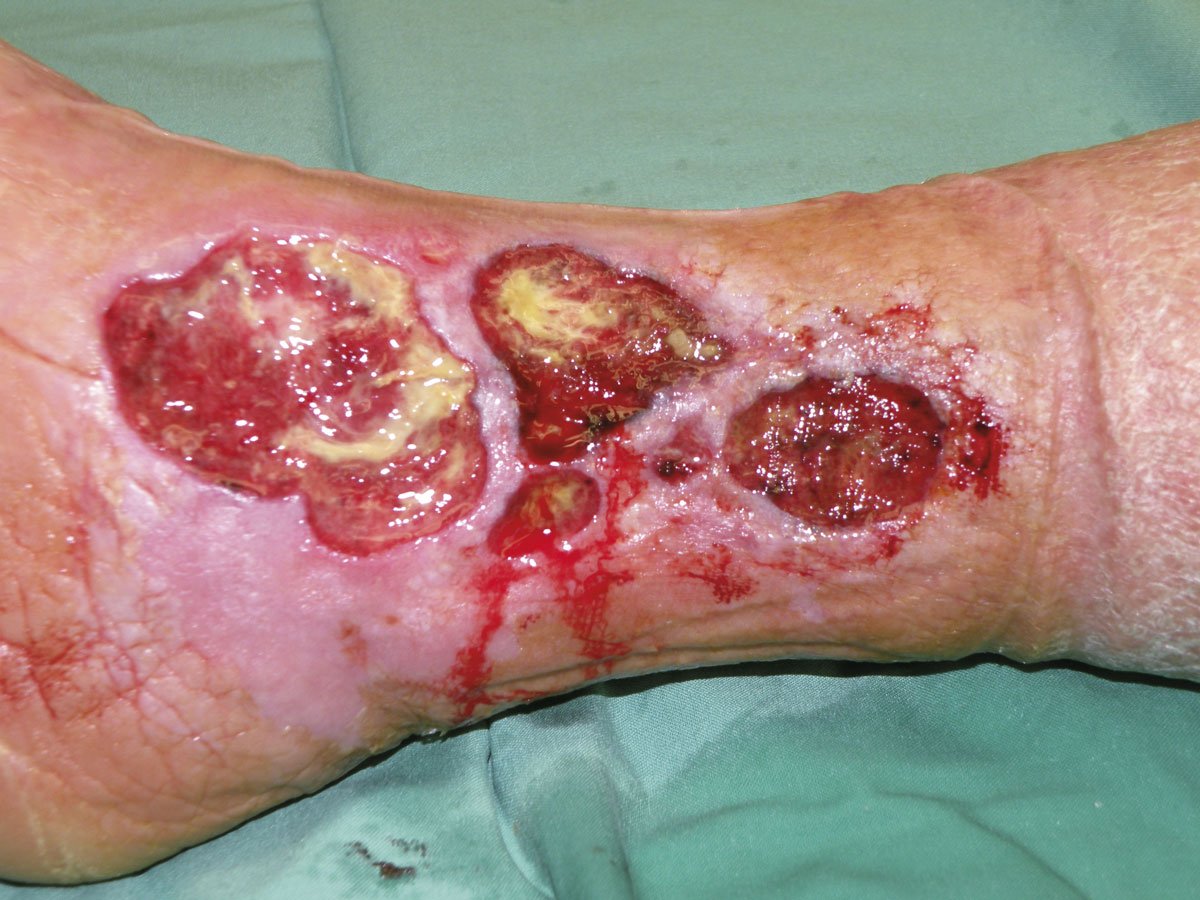 SuperMehr1li Stark exsudierende Ulzerationen am Unterschenkel bei Diabetes mellitus