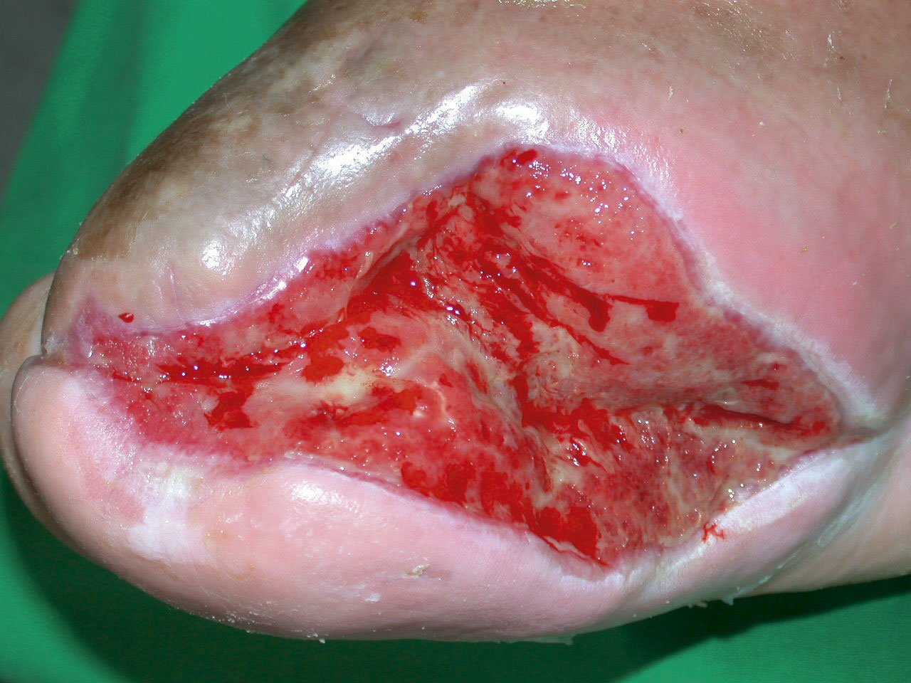 SuperMehr2re Stark exsudierende Wunde nach offener Vorfußamputation