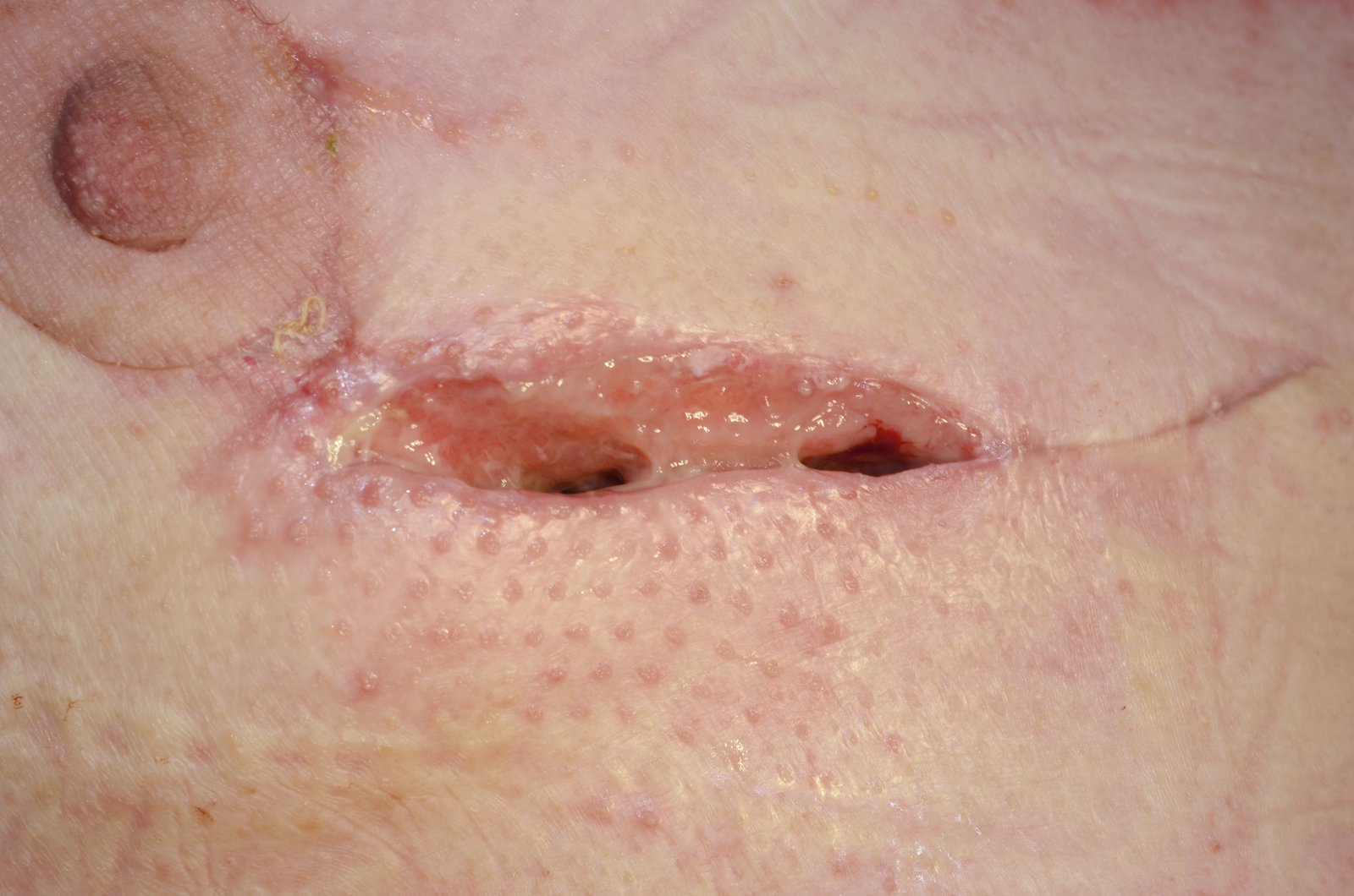 Vakuumver Kanisterlos2re Postoperative Wundheilungsstörung nach Mammareduktionsplastik