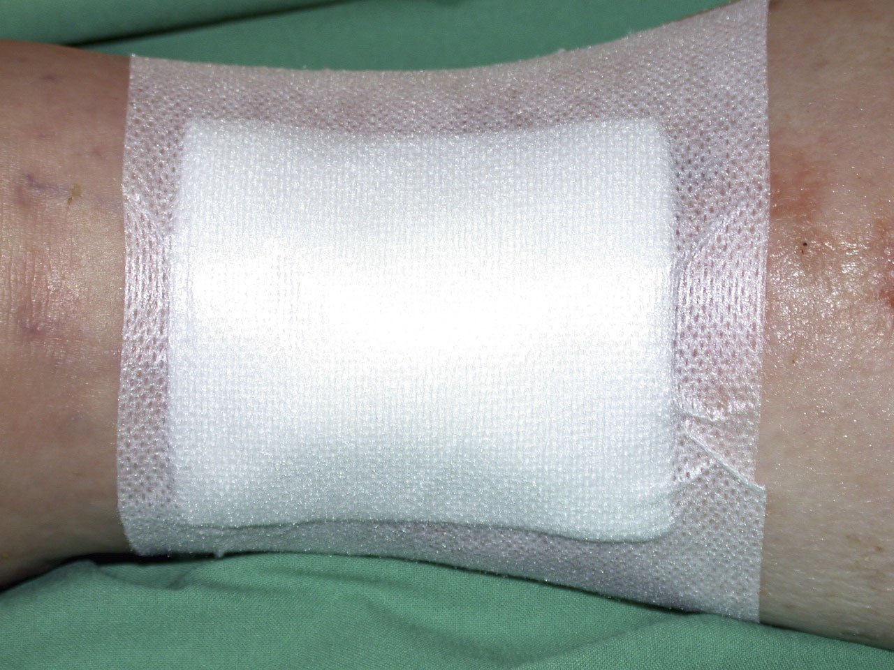 VerbFixier1li Vollflächige Fixierung eines Schaumverbandes