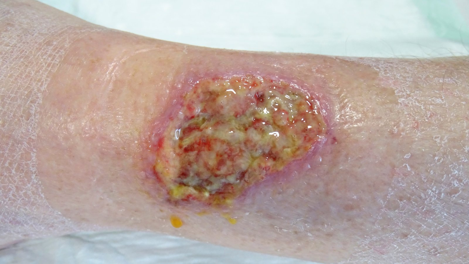 Wundreinigung1li Stark fibrin und biofilmgelegtes Ulcus curis venosum am US