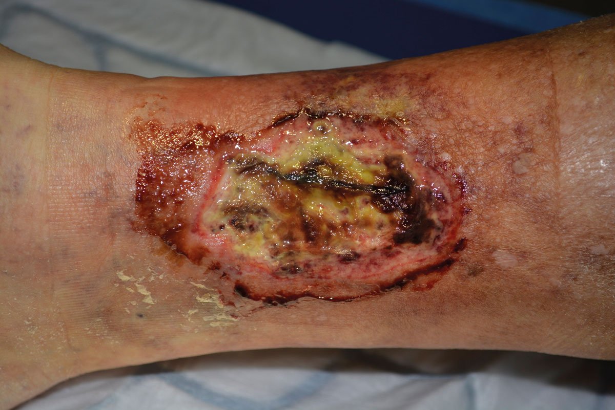 Wundreinigung - Teils nekrotisch belegtes Ulcus cruris arteriosum