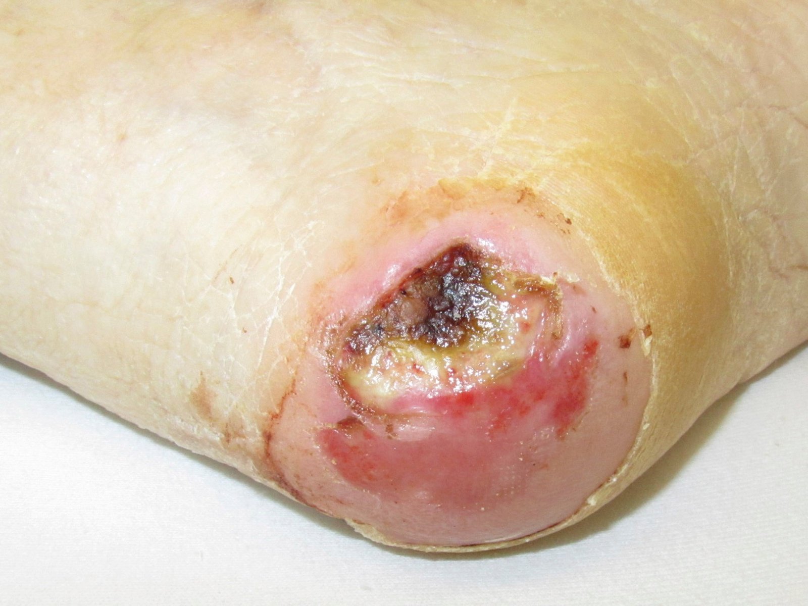 Wundspüllösung1li Druckulkus an der Ferse Fettgewebsnekrose kaum Exsudation