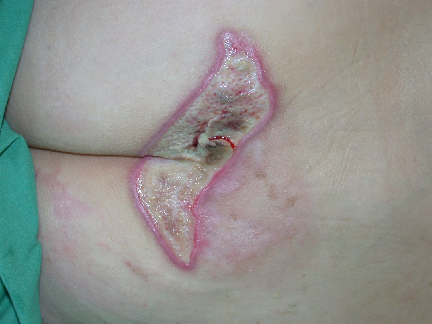 Wundspüllösung2re Dekubitus am Gesäß mit Restnekrosen am Wundgrund