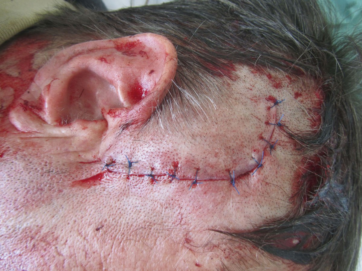 Wundverb.Saugkissen1li Traumatische Wunde an der Schläfe nach Erstversorgung durch Naht