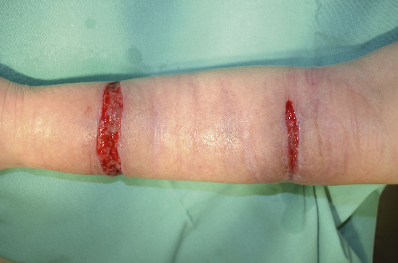 Wundverschluss1li 2 Schnittwunden am Unterarm bei Borderline Syndrom